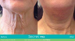 Secret Pro Neck | RSVP Beauty Clinic | Aesthetic Treatment Vancouver BC